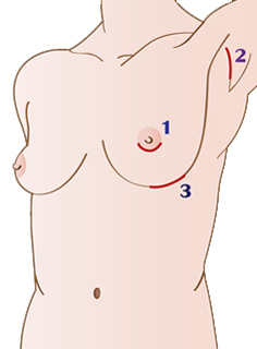 incision_of_breast_implant