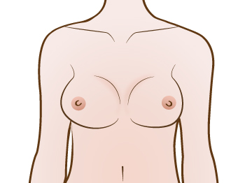 Shows Breast implant Capsular contracture