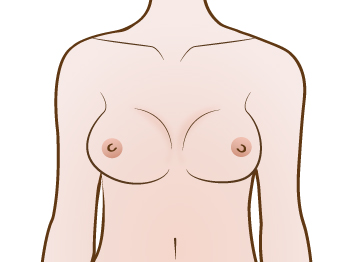 Breast_implant_Capsular_contracture