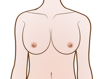 Shows Breast Upward position Implant
