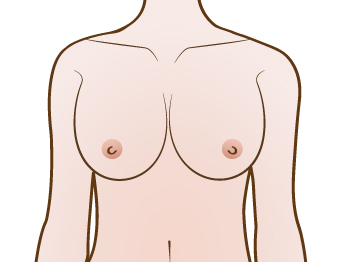 Breast_Upward_position_Implant