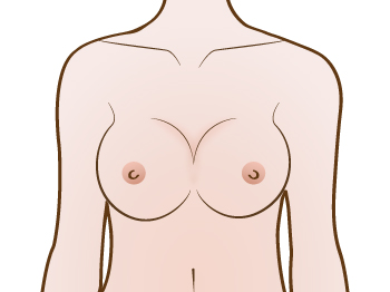 Shows Breast implant Symmastia or Uniboob correction