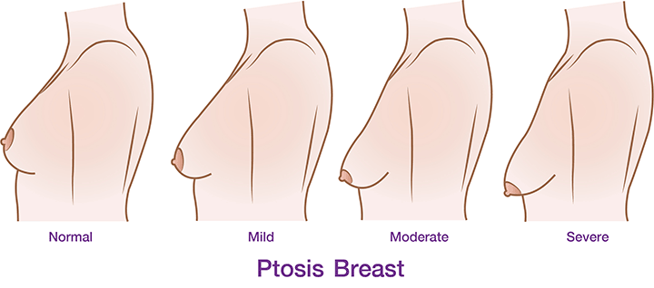 degree_of_ptosis