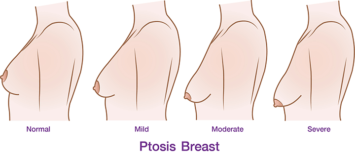 Shows the degee of posis breast