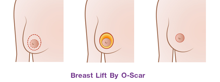 Shows breast lift by incision scar around areola (O-scar)