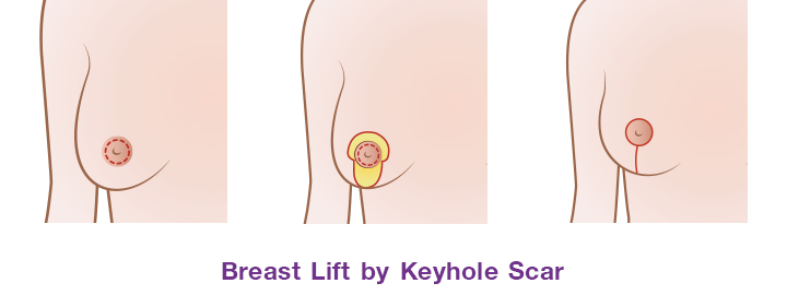 Shows breast lift by keyhole scar