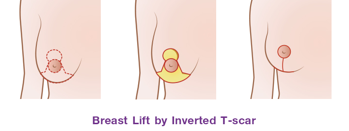 Shows breast lift by inverted T-scar
