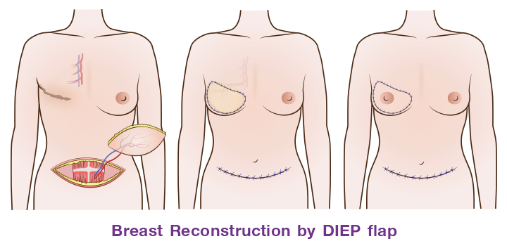 DIEP flap (Deep inferior epigastric perforator flap)