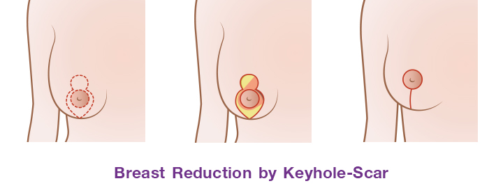 Breast reduction by Keyhole-scar