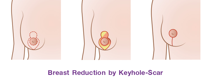 Breast_reduction_by_Keyhole-scar