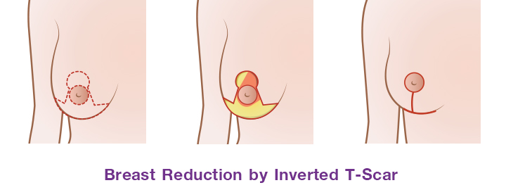 Shows breast reduction by inverted T-scar
