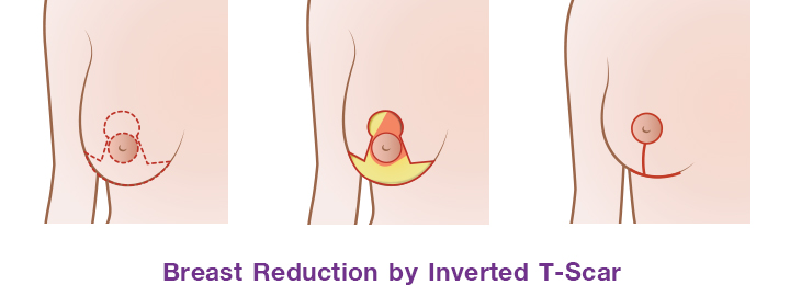 الصورة 2. ندبة T المقلوبة لتصغير الثدي