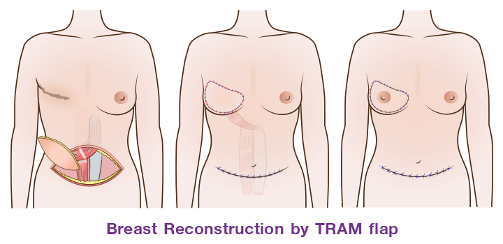 TRAM_flap_(Transverse_rectus_abdominis_muscle_flap)