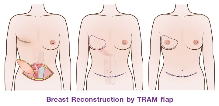 TRAM flap (Transverse rectus abdominis muscle flap)