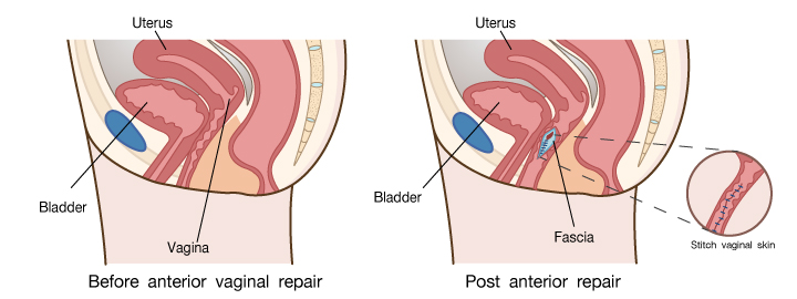 การผ่าตัดรีแพร์ช่องคลอดด้านหน้า