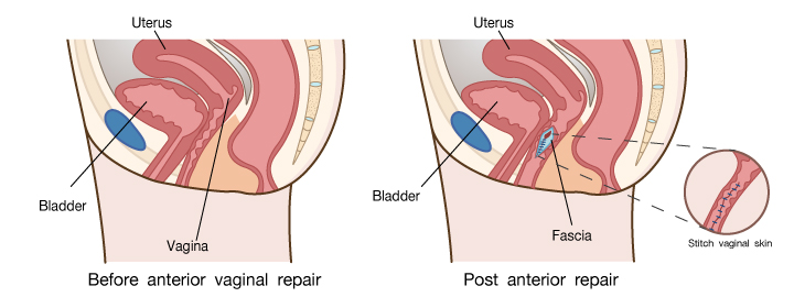 Show Anteria & Posteria vaginal repair