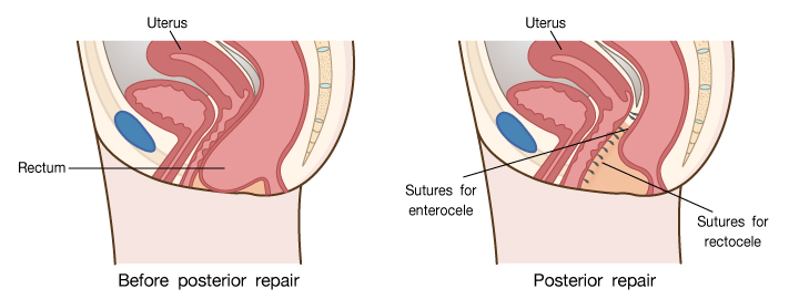 الصورة 2. عرض الإصلاح المهبلي الخلفي (P-Repair)