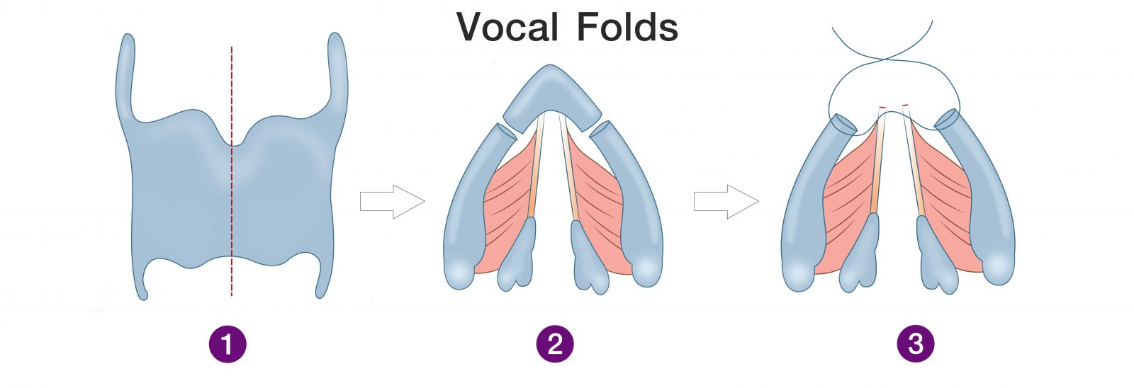 Open_laryngoplasty_with_anterior_vocal_fold_shaving_technique