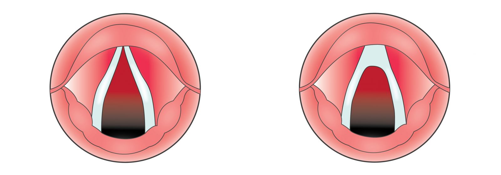 laryngoplasty_with_anterior_vocal_folds_shaving.