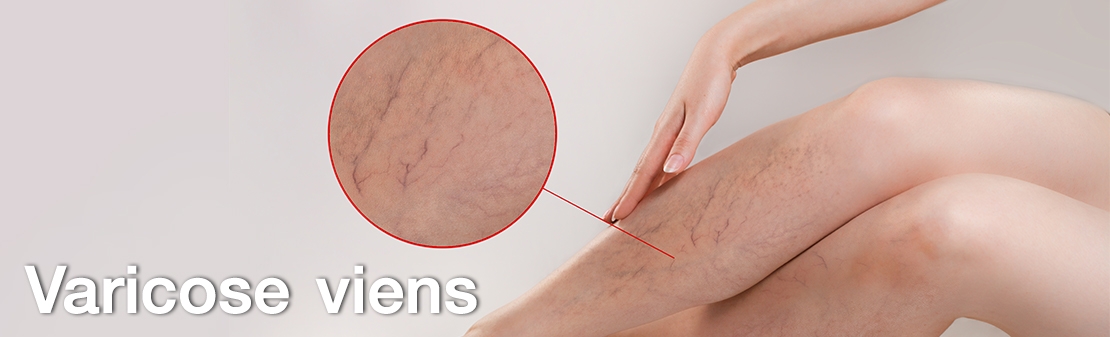 เส้นเลือดขอด (Varicose veins)