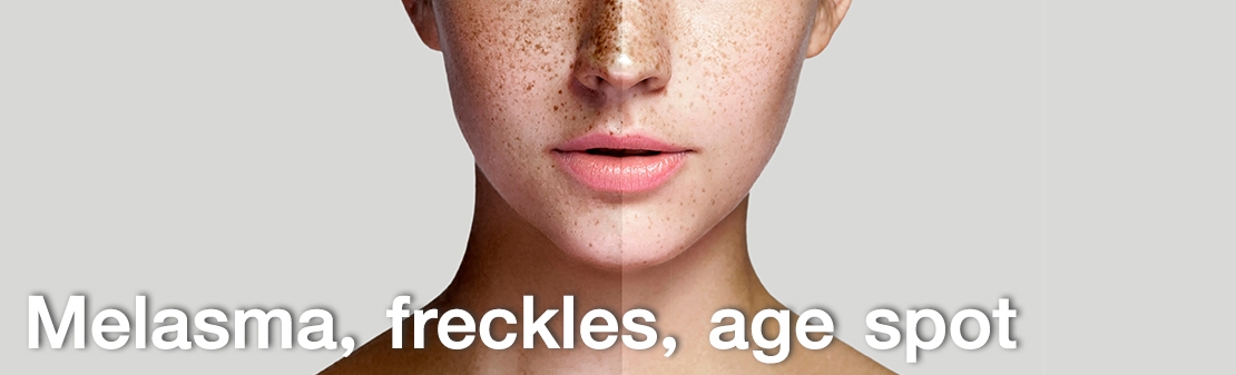 Melasma, freckles, age spot