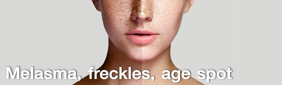 Melasma, Freckles, Age Spots
