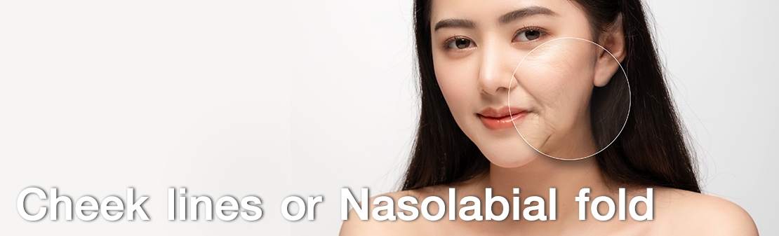 Cheek lines or Nasolabial fold