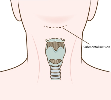 Adam’s_apple_position_and_the_incision