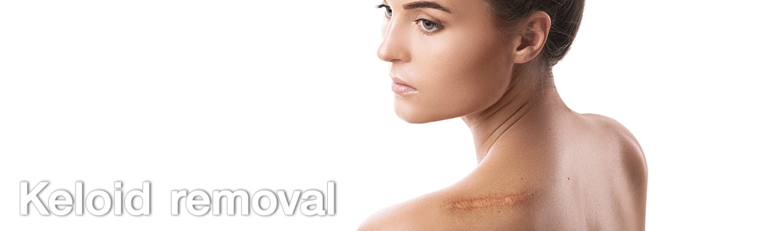 Keloid Removal