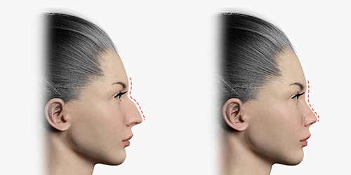 Shows before and after rhinoplasty by reducing the height of the nose bridge