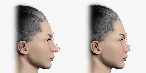 Shows before and after rhinoplasty by reducing the length of the nasal tip