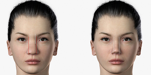 Shows_before_and_after_rhinoplasty_by_lateral_Osteotomy