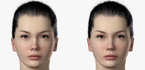 Shows before and after rhinoplasty by using a spreading graft