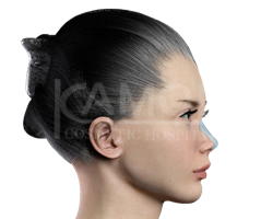 Silicone_Nose_Implant_/_Augmentation_Rhinoplasty