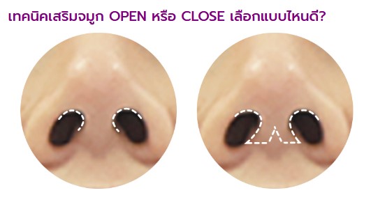Nose Implant /  Augmentation Rhinoplasty