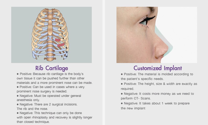 Advantage_of_rib cartilage_nose_implant_campare_with_customized_nose_implant